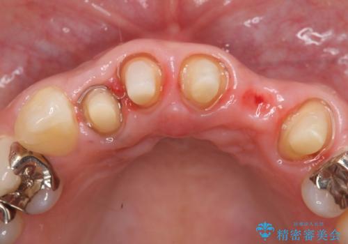 オールセラミッククラウン　気になる歯茎と被せ物の隙間の改善の治療中