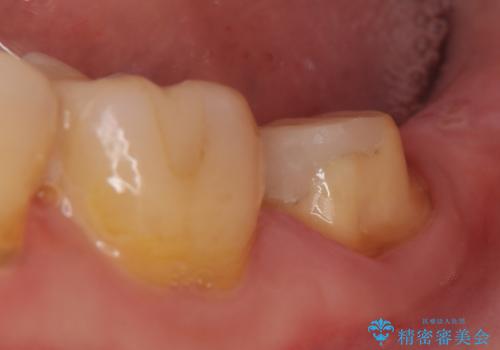 オールセラミッククラウン 痛みが引かない歯の治療の治療中