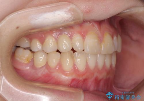 欠損と残存乳歯　矯正治療とインプラント治療の治療後