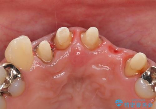 オールセラミッククラウン 気になる歯茎と被せ物の隙間の改善の治療中