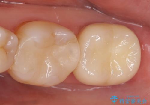 オールセラミッククラウン 痛みが引かない歯の治療の治療後