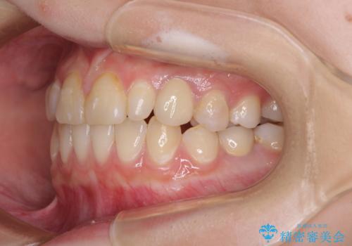 欠損と残存乳歯 矯正治療とインプラント治療の治療後