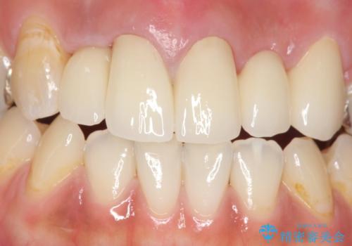 オールセラミッククラウン　気になる歯茎と被せ物の隙間の改善の治療後