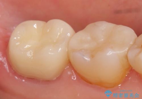 オールセラミッククラウン 痛みが引かない歯の治療の治療後