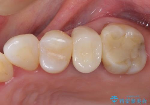 歯肉の退縮により歯根が見える　オールセラミッククラウンによる審美歯科治療の症例 治療後