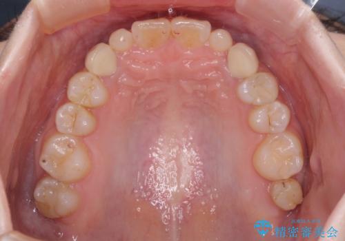 欠損と残存乳歯 矯正治療とインプラント治療の治療後