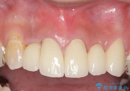 オールセラミッククラウン 気になる歯茎と被せ物の隙間の改善の症例 治療後