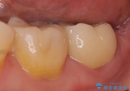 オールセラミッククラウン 痛みが引かない歯の治療の治療後