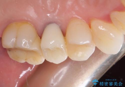 歯肉の退縮により歯根が見える　オールセラミッククラウンによる審美歯科治療の治療後