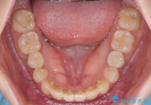 欠損と残存乳歯 矯正治療とインプラント治療の治療後