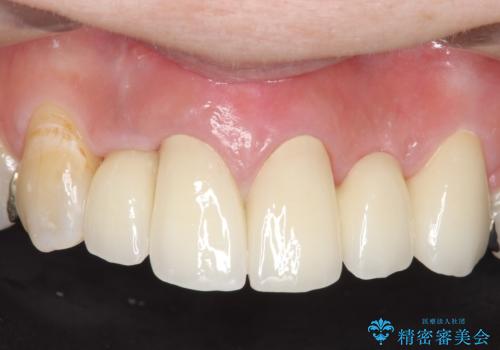 オールセラミッククラウン　気になる歯茎と被せ物の隙間の改善の治療後
