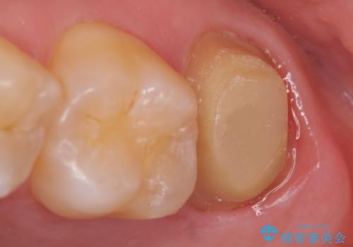 オールセラミッククラウン 痛くて咬めない歯の治療の治療中