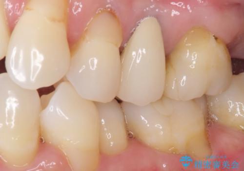 歯肉の退縮により歯根が見える オールセラミッククラウンによる審美歯科治療の治療後