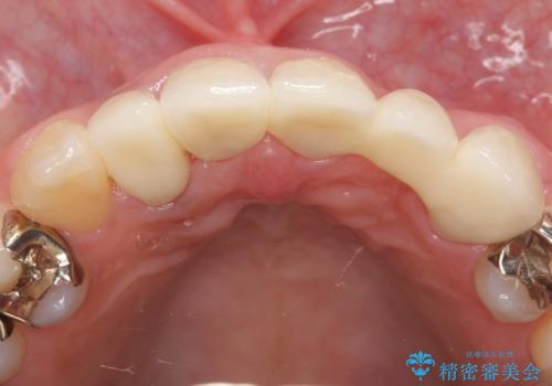 オールセラミッククラウン 気になる歯茎と被せ物の隙間の改善の治療後