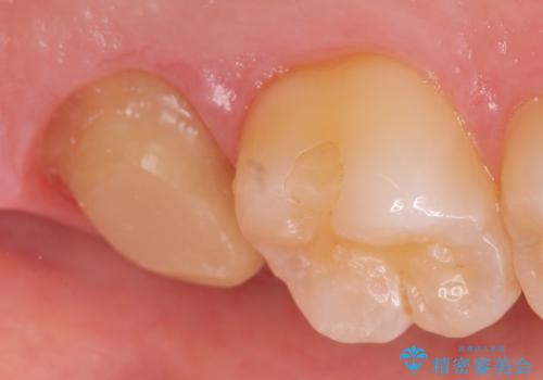 オールセラミッククラウン 痛くて咬めない歯の治療の治療中