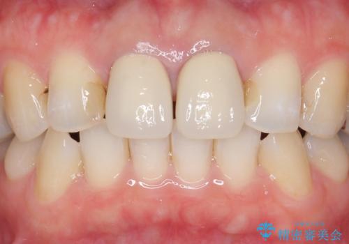 オールセラミッククラウン　前歯の劣化した古い樹脂をセラミックにの治療前