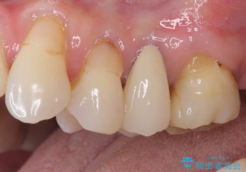 歯肉の退縮により歯根が見える オールセラミッククラウンによる審美歯科治療の治療後