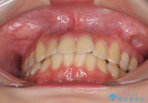 軽度な後戻りをインビザライン・ライトで改善の治療前