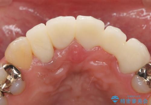 オールセラミッククラウン 気になる歯茎と被せ物の隙間の改善の治療後