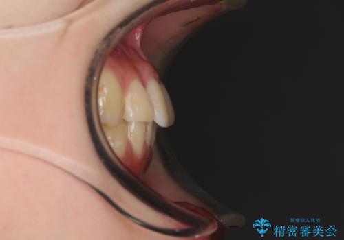 軽度な後戻りをインビザライン・ライトで改善の治療前