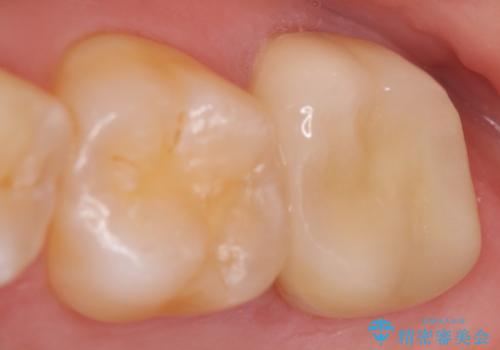 オールセラミッククラウン 痛くて咬めない歯の治療