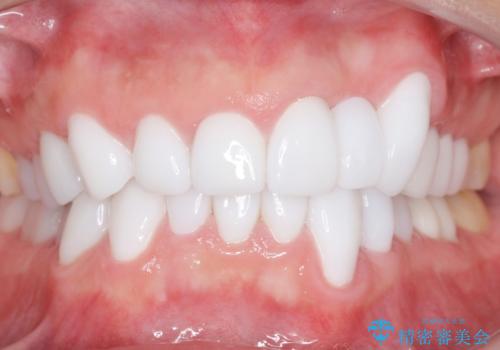 歯並びをきれいにしたい、歯を真っ白にしたい 40代男性の治療後