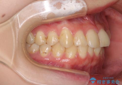 軽度な後戻りをインビザライン・ライトで改善の治療前