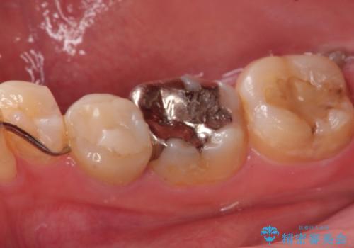 目立つ銀歯を白くしたい セラミック治療の治療前