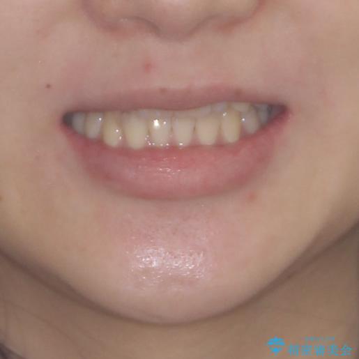 欠損と残存乳歯　矯正治療とインプラント治療の治療後（顔貌）