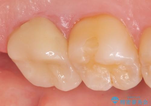 オールセラミッククラウン 痛くて咬めない歯の治療の治療後