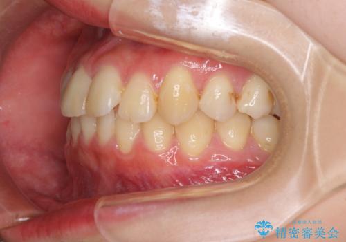 軽度な後戻りをインビザライン・ライトで改善の治療前