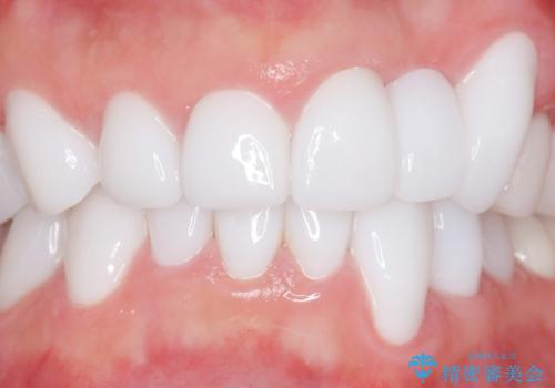 歯並びをきれいにしたい、歯を真っ白にしたい 40代男性の治療後