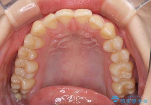 軽度な後戻りをインビザライン・ライトで改善の治療前