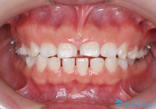 インビザライン 気になるすきっ歯の改善の治療中