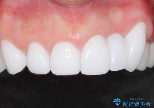 歯並びをきれいにしたい、歯を真っ白にしたい 40代男性の治療後
