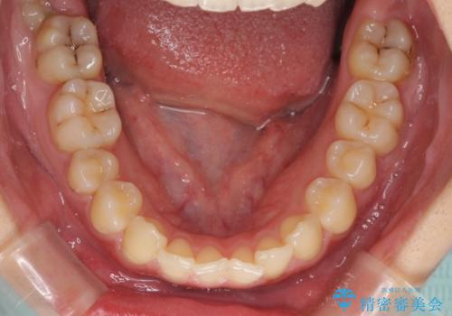 軽度な後戻りをインビザライン・ライトで改善の治療前