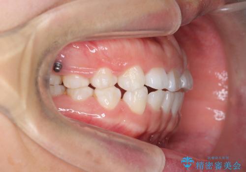 インビザライン 気になるすきっ歯の改善の治療中