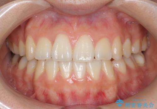 オフィスホワイトニングで歯を白く!の治療前