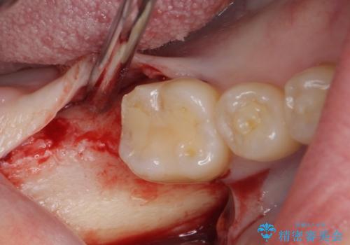 抜歯されたままの奥歯　ストローマンインプラントによる欠損補綴治療の治療前