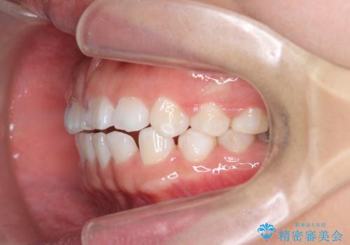 インビザライン　気になるすきっ歯の改善の治療中