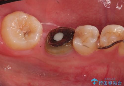 目立つ銀歯を白くしたい セラミック治療の治療前