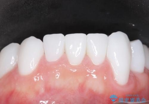 歯並びをきれいにしたい、歯を真っ白にしたい 40代男性の治療後