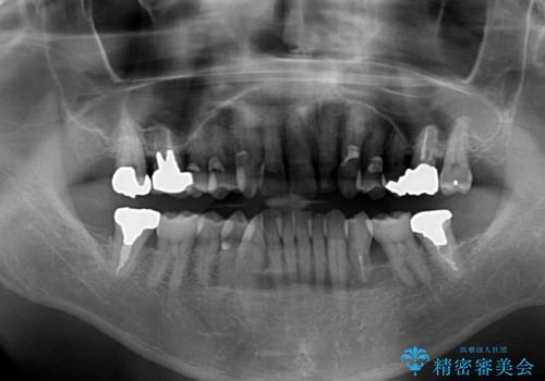 矯正治療と歯周外科処置を併用した審美歯科治療の治療前