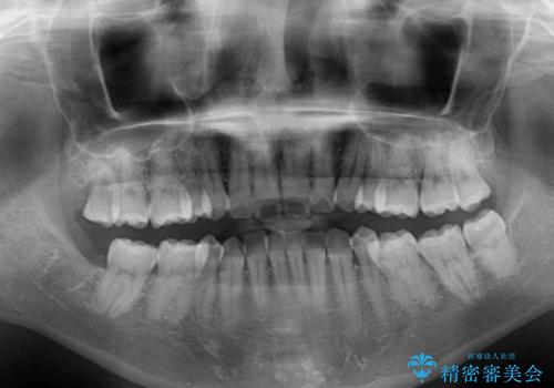 抜歯矯正の後戻り インビザラインによる再矯正治療の治療前