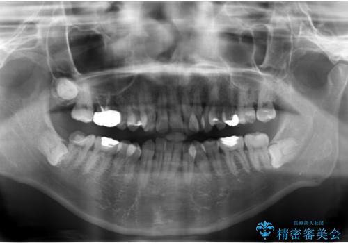 歯並びをきれいにしたい、歯を真っ白にしたい 40代男性の治療前
