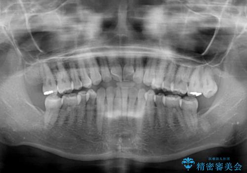 前歯の叢生と切端咬合 インビザラインによる矯正治療の治療前