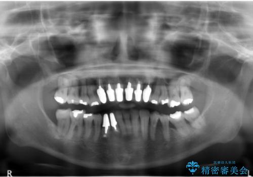 歯周病　インプラントによる咬合機能回復の治療前