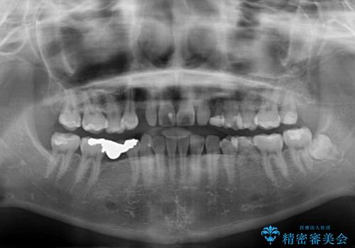 欠損と残存乳歯 矯正治療とインプラント治療の治療前