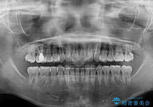 前歯のデコボコを治したい インビザラインによる矯正治療の治療後