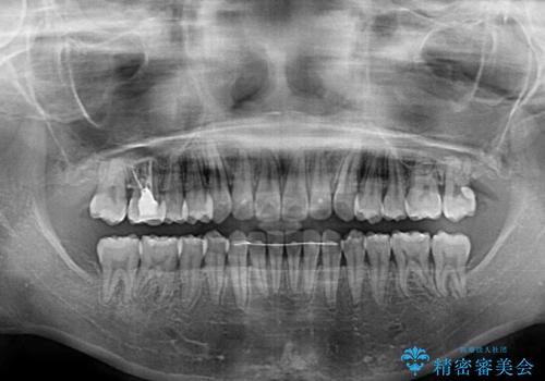 前歯のデコボコを治したい　インビザラインによる矯正治療の治療後